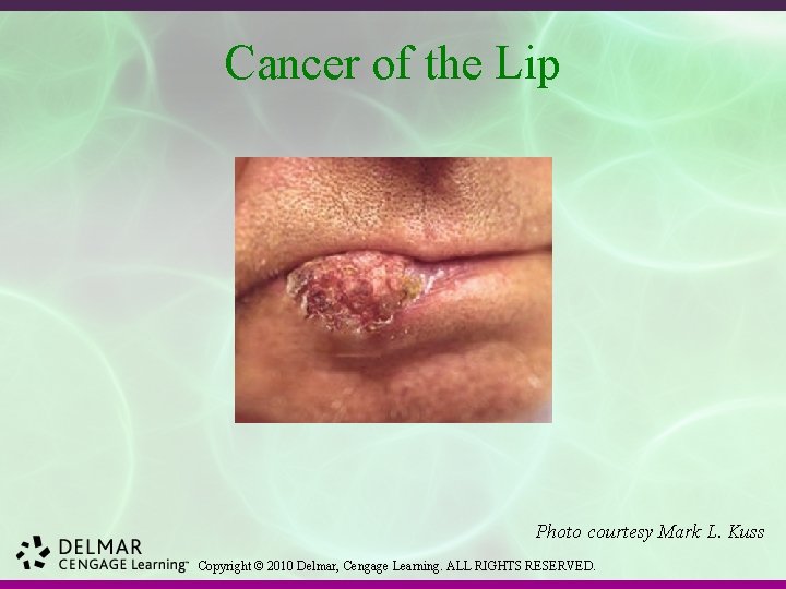 Cancer of the Lip Photo courtesy Mark L. Kuss Copyright © 2010 Delmar, Cengage