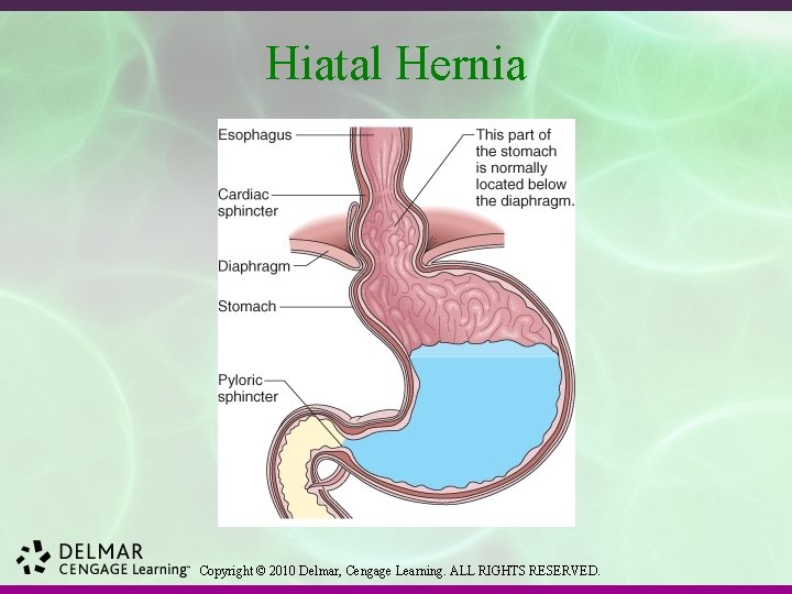 Hiatal Hernia Copyright © 2010 Delmar, Cengage Learning. ALL RIGHTS RESERVED. 