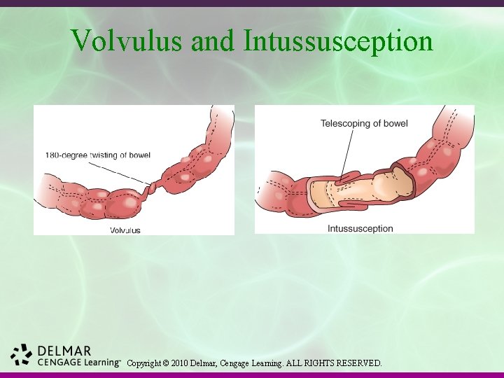 Volvulus and Intussusception Copyright © 2010 Delmar, Cengage Learning. ALL RIGHTS RESERVED. 