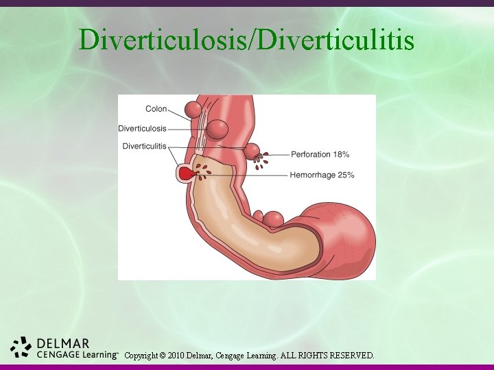 Diverticulosis/Diverticulitis Copyright © 2010 Delmar, Cengage Learning. ALL RIGHTS RESERVED. 