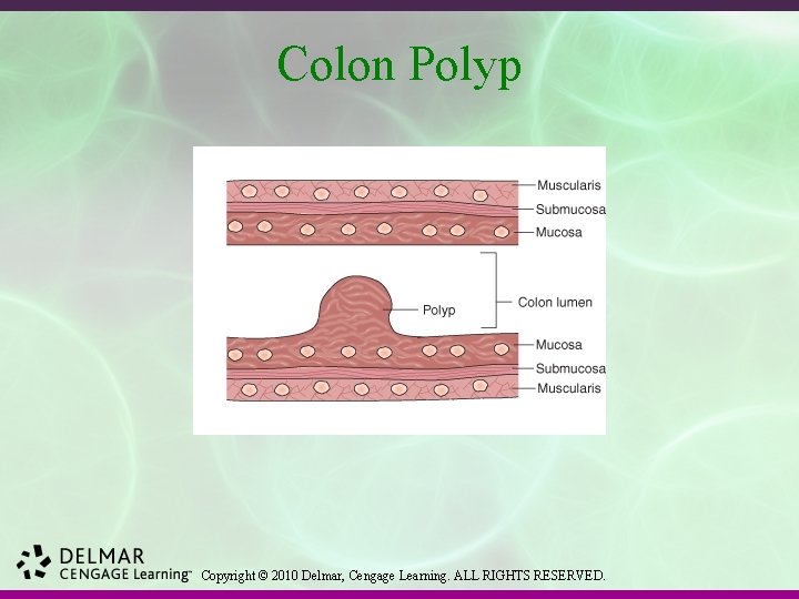 Colon Polyp Copyright © 2010 Delmar, Cengage Learning. ALL RIGHTS RESERVED. 