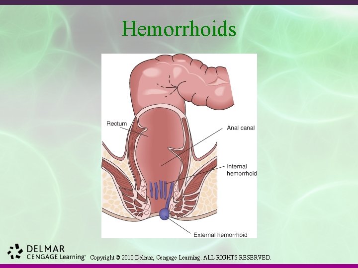 Hemorrhoids Copyright © 2010 Delmar, Cengage Learning. ALL RIGHTS RESERVED. 