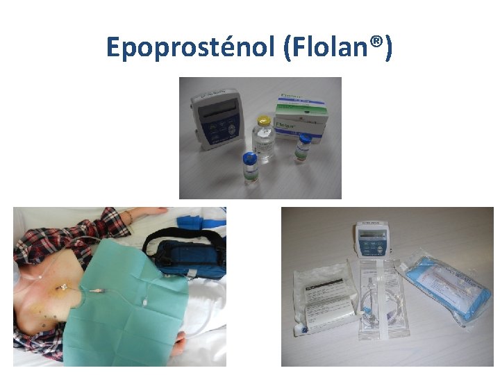 Epoprosténol (Flolan®) Epoprosténol (Flolan®)