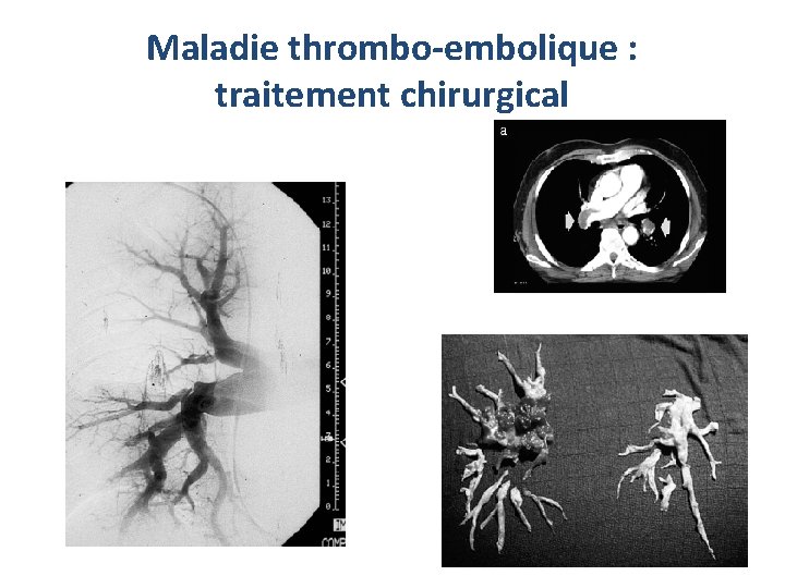 Maladie thrombo-embolique : traitement chirurgical Maladie thrombo-embolique : traitement chirurgical