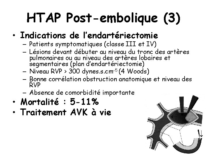 HTAP Post-embolique (3) • Indications de l’endartériectomie – Patients symptomatiques (classe III et IV) HTAP Post-embolique (3) • Indications de l’endartériectomie – Patients symptomatiques (classe III et IV)