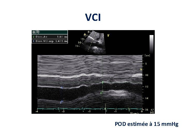 VCI POD estimée à 15 mm. Hg VCI POD estimée à 15 mm. Hg