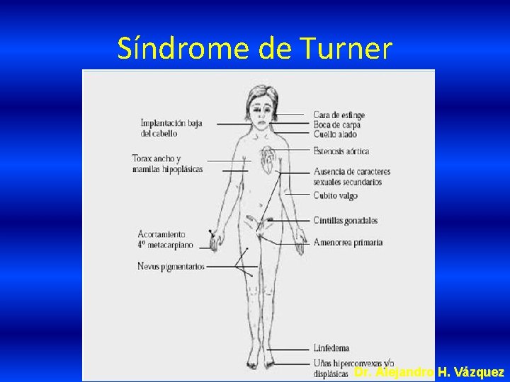 Síndrome de Turner Dr. Alejandro H. Vázquez 