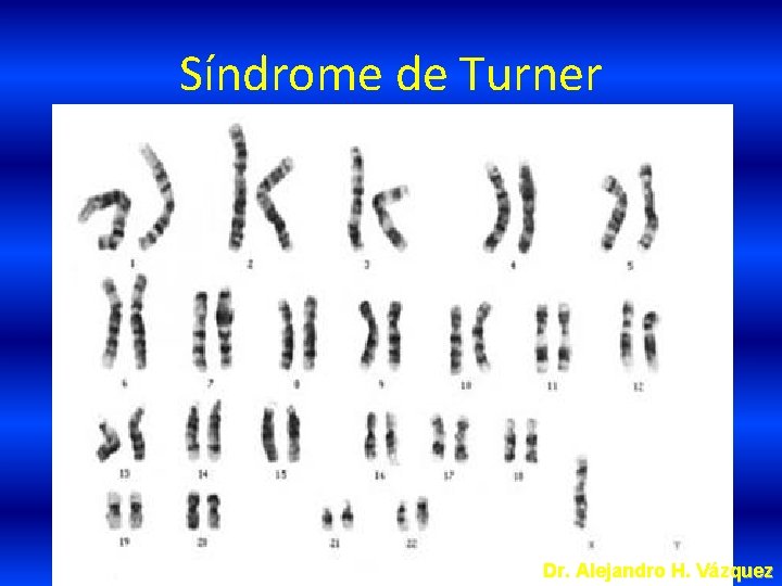 Síndrome de Turner Dr. Alejandro H. Vázquez 