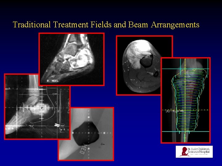 Traditional Treatment Fields and Beam Arrangements 