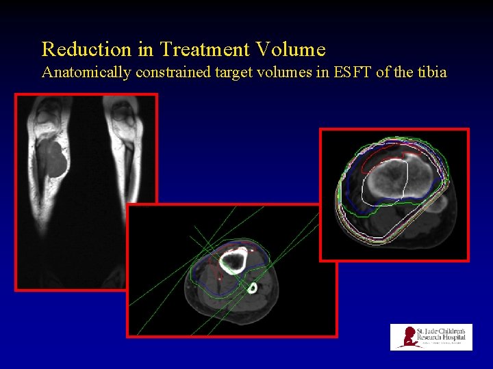 Reduction in Treatment Volume Anatomically constrained target volumes in ESFT of the tibia 