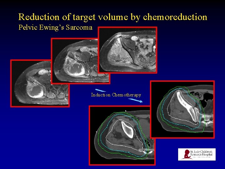 Reduction of target volume by chemoreduction Pelvic Ewing’s Sarcoma Induction Chemotherapy 