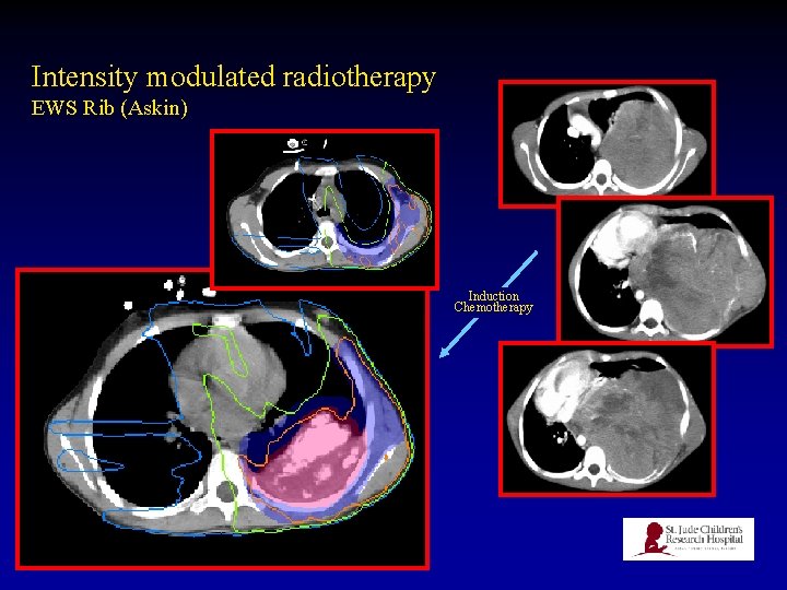 Intensity modulated radiotherapy EWS Rib (Askin) Induction Chemotherapy 