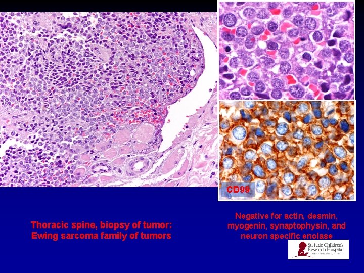 CD 99 Thoracic spine, biopsy of tumor: Ewing sarcoma family of tumors Negative for