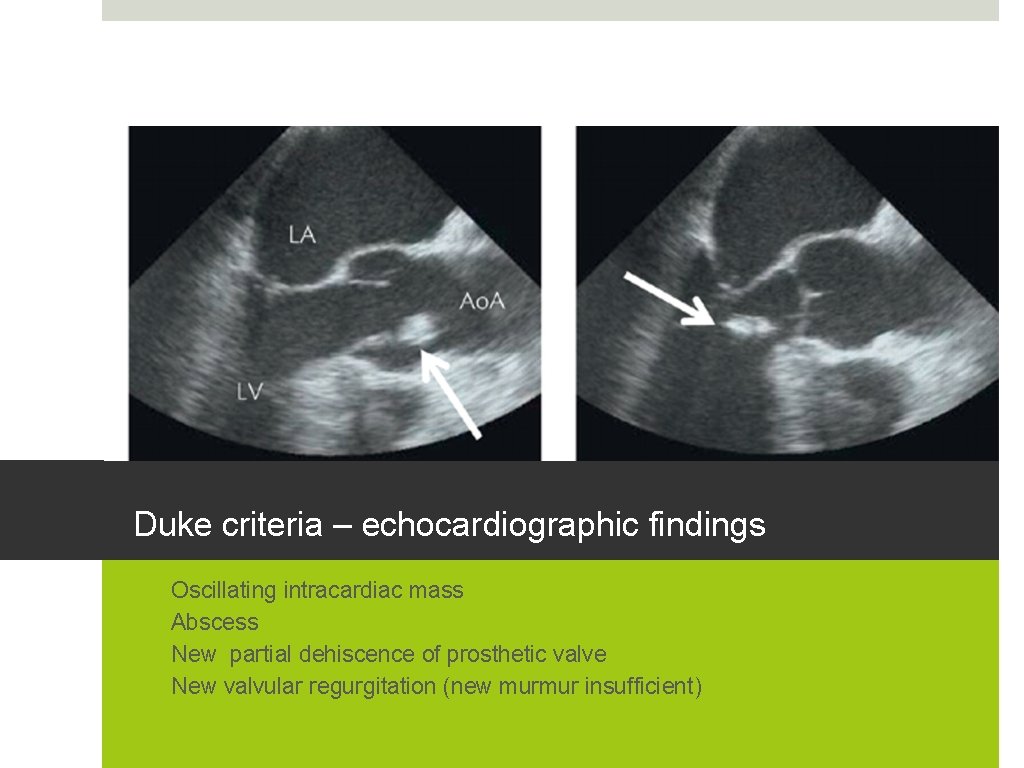 Duke criteria – echocardiographic findings 1. 2. 3. 4. Oscillating intracardiac mass Abscess New