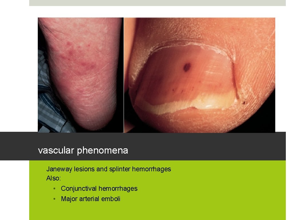 vascular phenomena • Janeway lesions and splinter hemorrhages • Also: • Conjunctival hemorrhages •