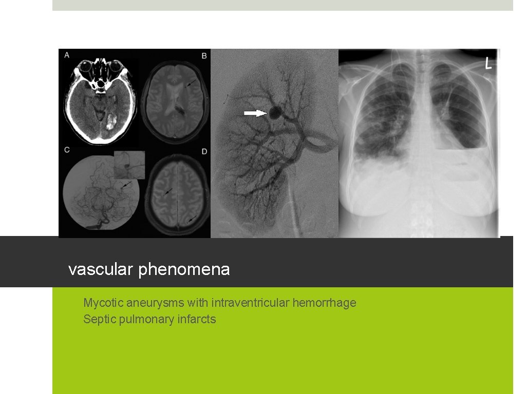 vascular phenomena • Mycotic aneurysms with intraventricular hemorrhage • Septic pulmonary infarcts 