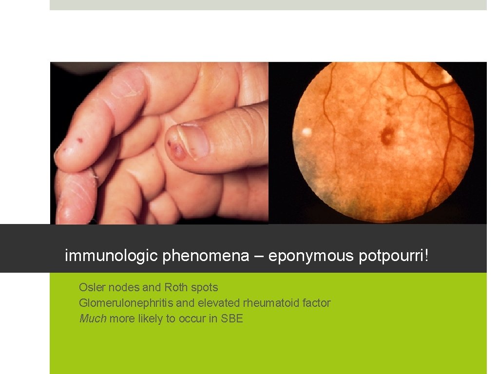 immunologic phenomena – eponymous potpourri! • Osler nodes and Roth spots • Glomerulonephritis and