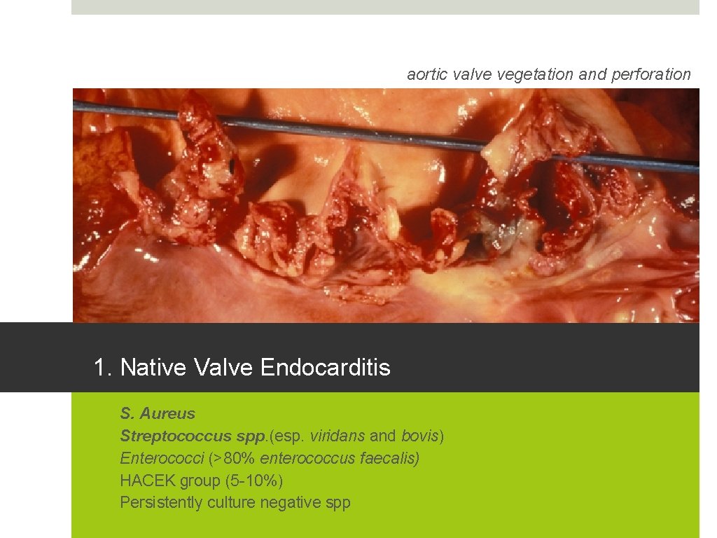 aortic valve vegetation and perforation 1. Native Valve Endocarditis 1. 2. 3. 4. 5.