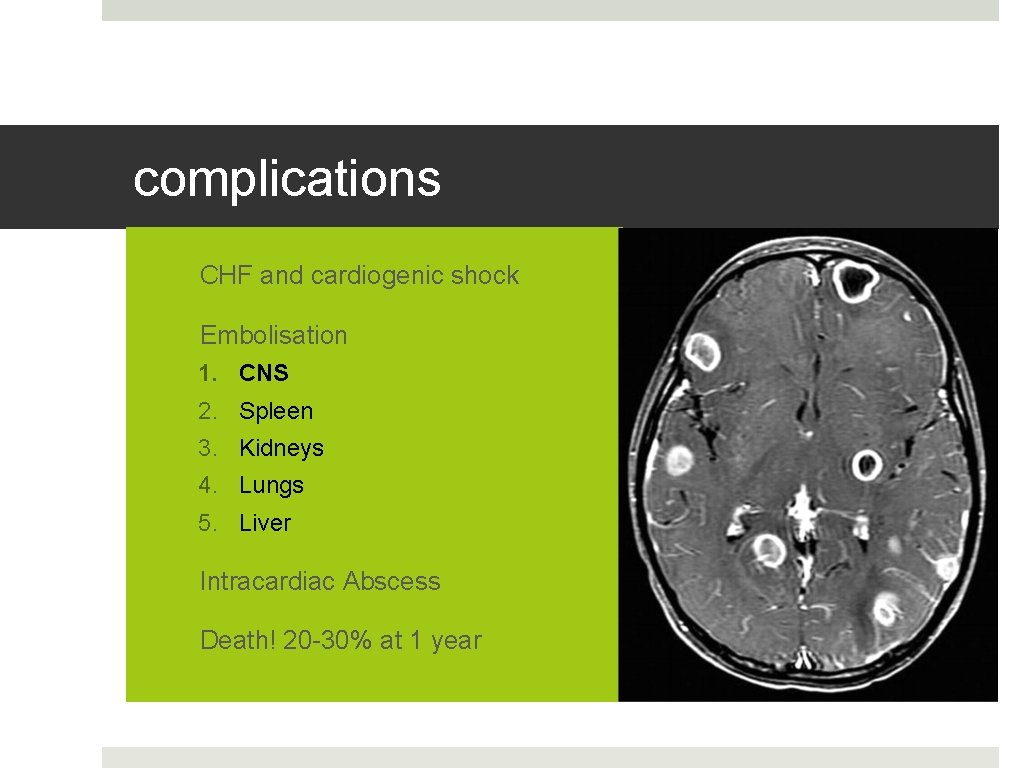 complications 1. CHF and cardiogenic shock 2. Embolisation 1. CNS 2. Spleen 3. Kidneys