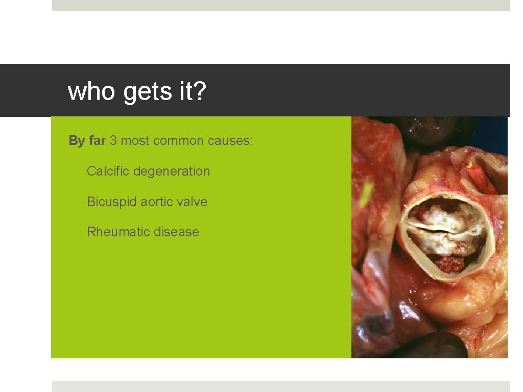 who gets it? By far 3 most common causes: • Calcific degeneration • Bicuspid