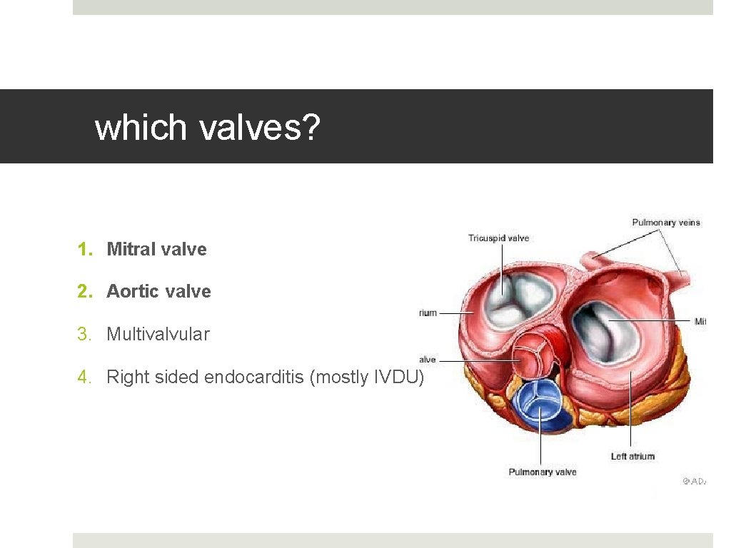 which valves? 1. Mitral valve 2. Aortic valve 3. Multivalvular 4. Right sided endocarditis