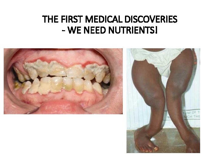 THE FIRST MEDICAL DISCOVERIES - WE NEED NUTRIENTS! 