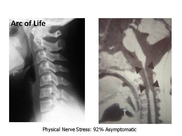 Arc of Life Physical Nerve Stress: 92% Asymptomatic 