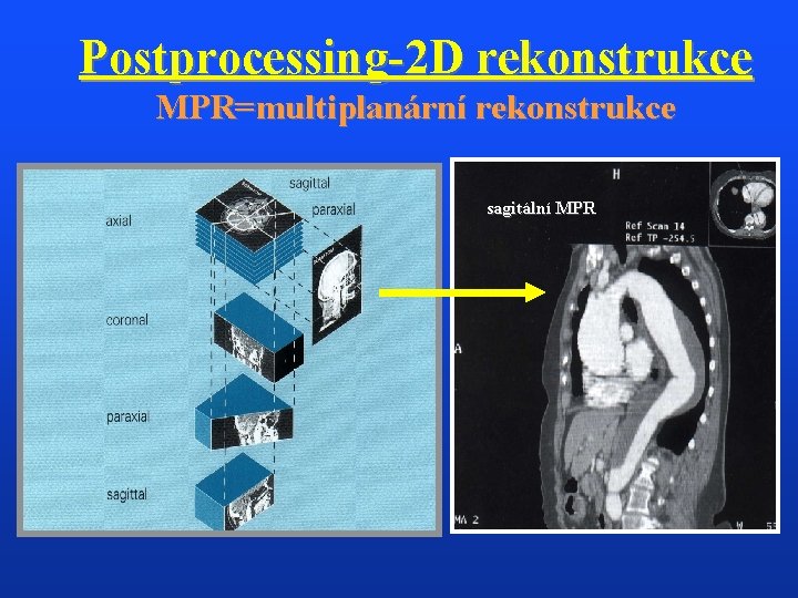 Postprocessing-2 D rekonstrukce MPR=multiplanární rekonstrukce sagitální MPR 