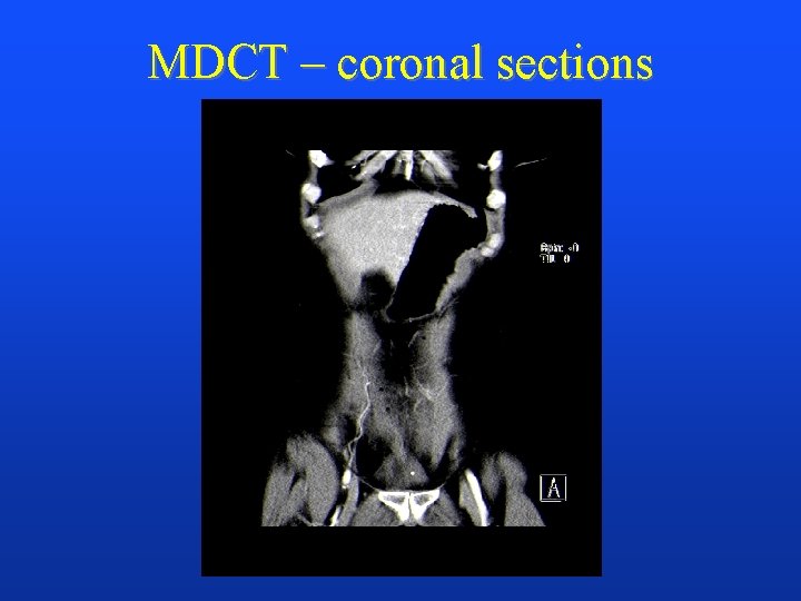 MDCT – coronal sections 