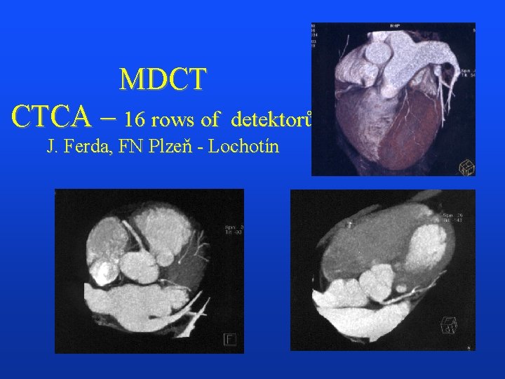 MDCT CTCA – 16 rows of detektorů J. Ferda, FN Plzeň - Lochotín 