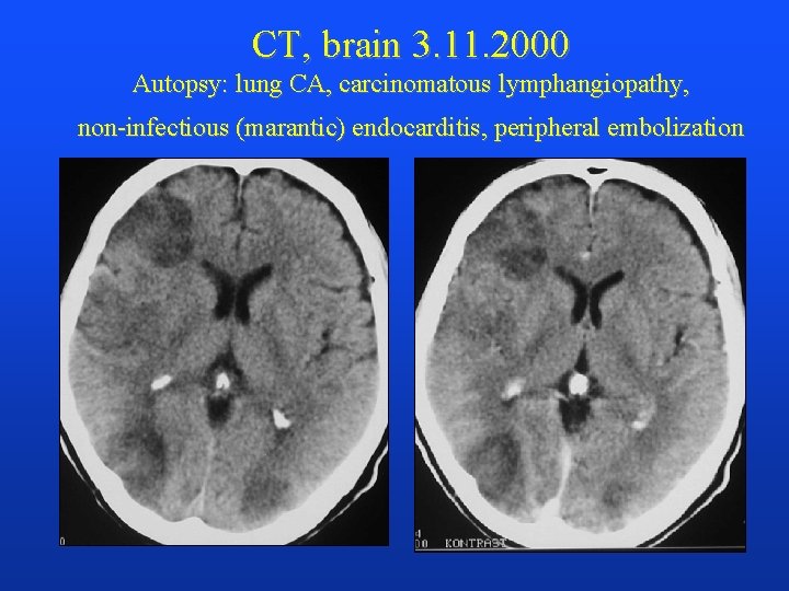CT, brain 3. 11. 2000 Autopsy: lung CA, carcinomatous lymphangiopathy, non-infectious (marantic) endocarditis, peripheral