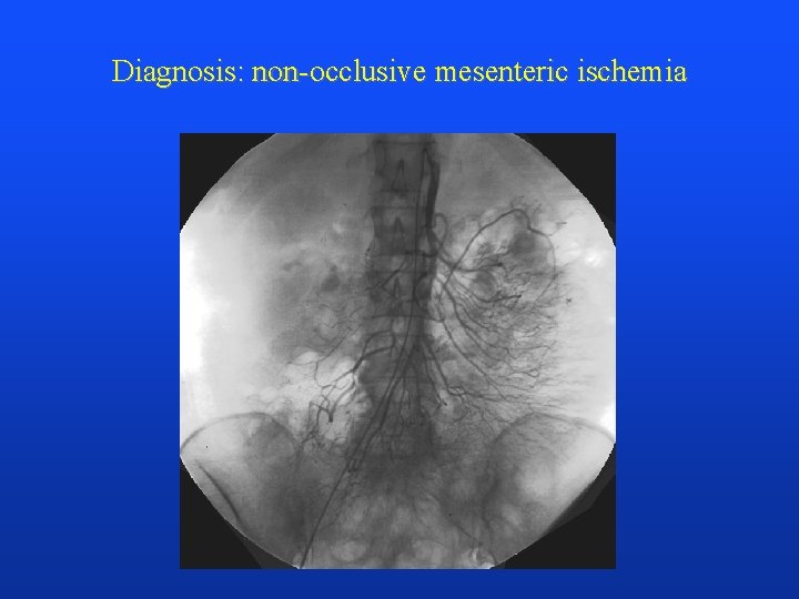 Diagnosis: non-occlusive mesenteric ischemia 