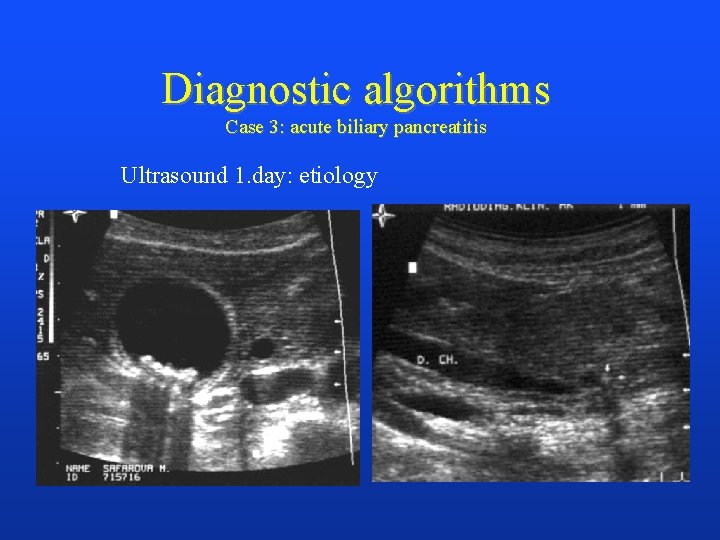 Diagnostic algorithms Case 3: acute biliary pancreatitis Ultrasound 1. day: etiology 