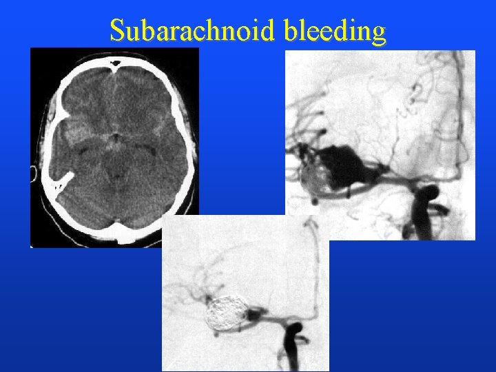 Subarachnoid bleeding 