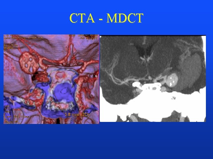 CTA - MDCT 
