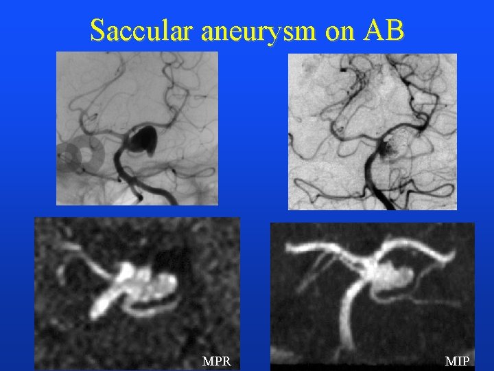 Saccular aneurysm on AB MPR MIP 
