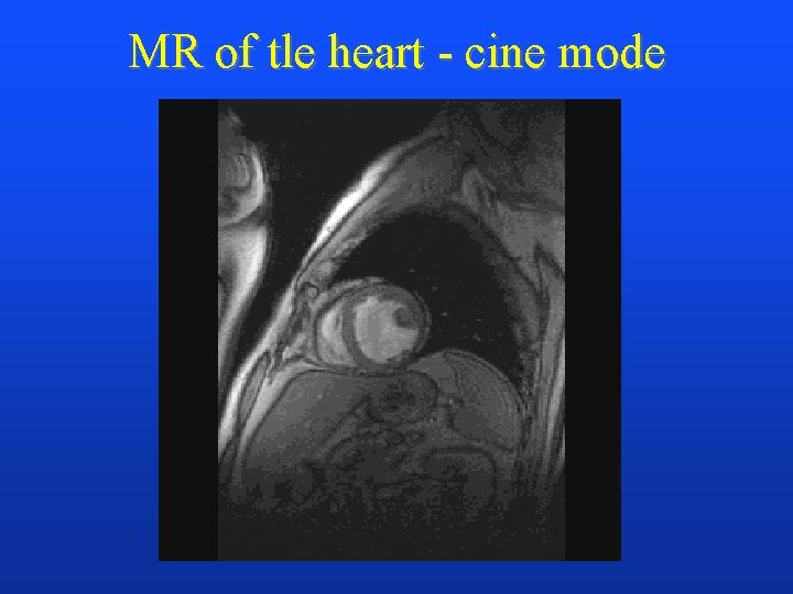 MR of tle heart - cine mode 