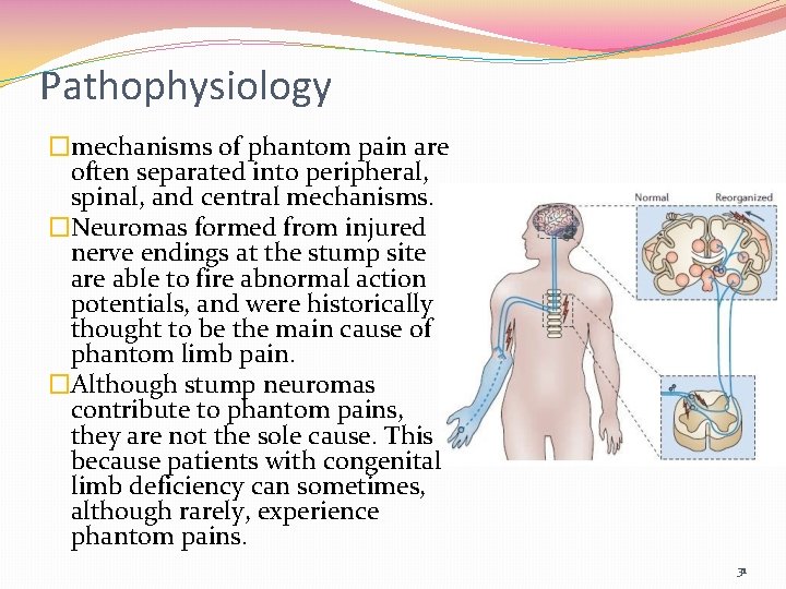 Pathophysiology �mechanisms of phantom pain are often separated into peripheral, spinal, and central mechanisms.