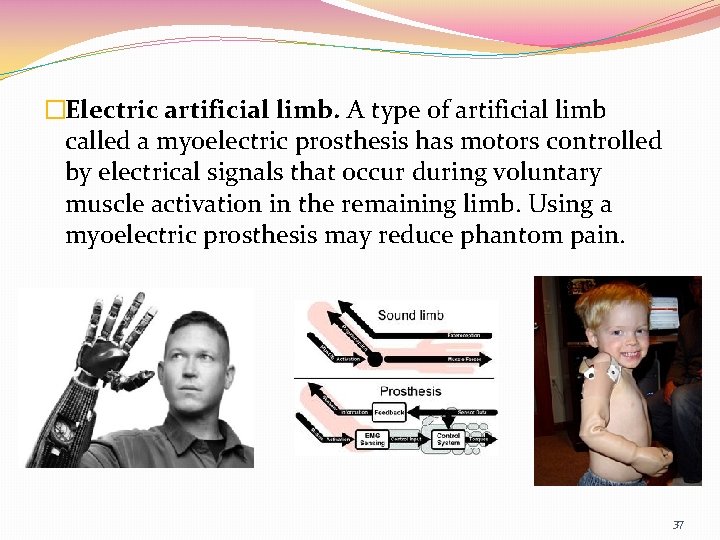 �Electric artificial limb. A type of artificial limb called a myoelectric prosthesis has motors