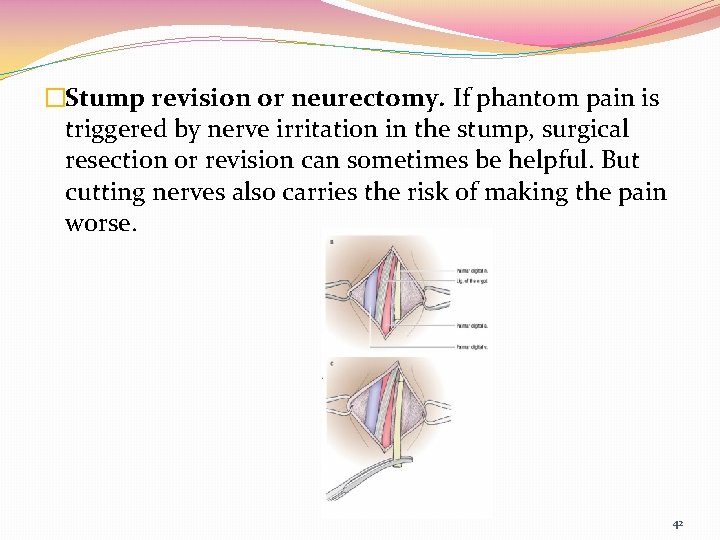�Stump revision or neurectomy. If phantom pain is triggered by nerve irritation in the