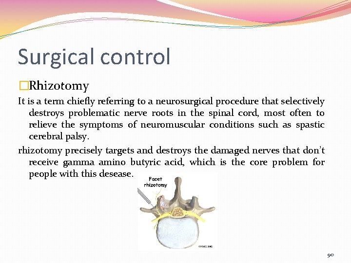 Surgical control �Rhizotomy It is a term chiefly referring to a neurosurgical procedure that