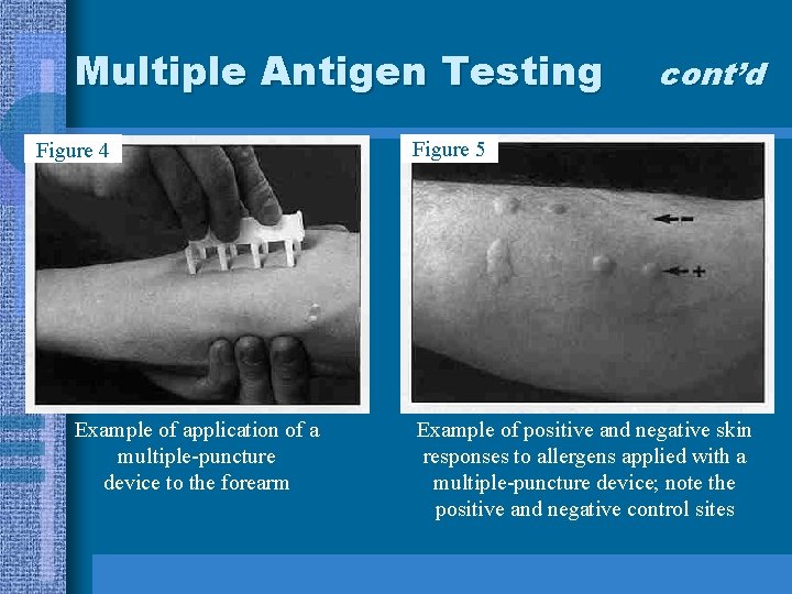 Multiple Antigen Testing Figure 4 Example of application of a multiple-puncture device to the