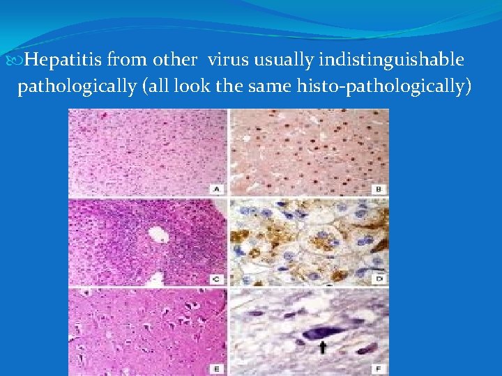  Hepatitis from other virus usually indistinguishable pathologically (all look the same histo-pathologically) 