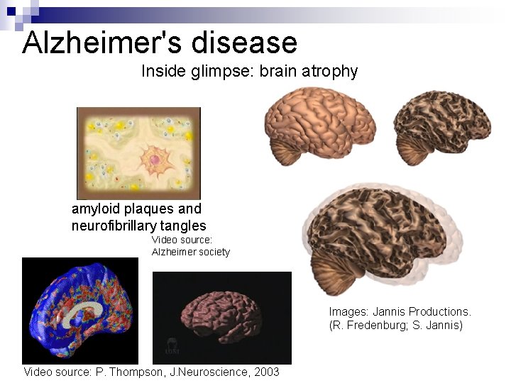 Alzheimer's disease Inside glimpse: brain atrophy amyloid plaques and neurofibrillary tangles Video source: Alzheimer