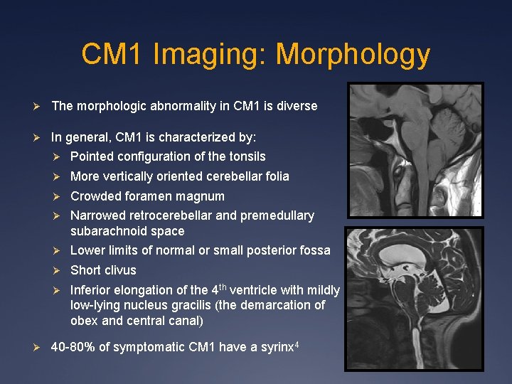 CM 1 Imaging: Morphology Ø The morphologic abnormality in CM 1 is diverse Ø