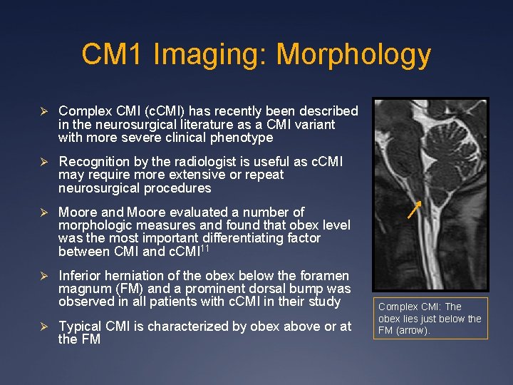 CM 1 Imaging: Morphology Ø Complex CMI (c. CMI) has recently been described in CM 1 Imaging: Morphology Ø Complex CMI (c. CMI) has recently been described in