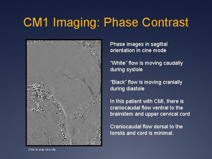 CM 1 Imaging: Phase Contrast Phase images in sagittal orientation in cine mode “White” CM 1 Imaging: Phase Contrast Phase images in sagittal orientation in cine mode “White”