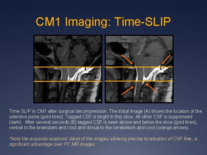 CM 1 Imaging: Time-SLIP A B Time-SLIP in CM 1 after surgical decompression. The