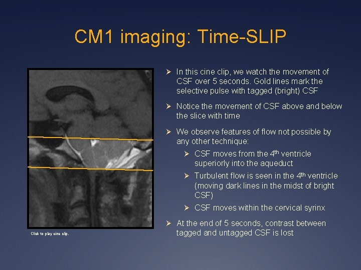 CM 1 imaging: Time-SLIP Ø In this cine clip, we watch the movement of