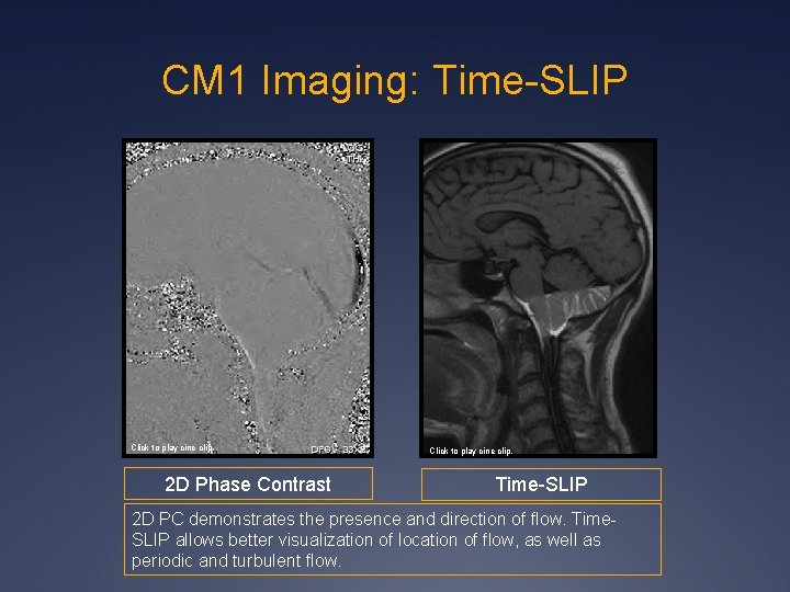 CM 1 Imaging: Time-SLIP Click to play cine clip. 2 D Phase Contrast Click CM 1 Imaging: Time-SLIP Click to play cine clip. 2 D Phase Contrast Click